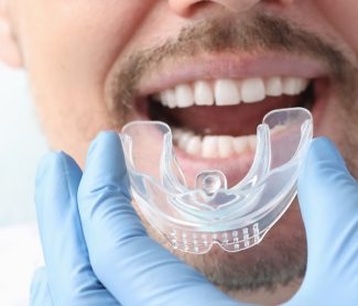 How Should a Mouthguard Fit? Ensuring Maximum Protection for Your Teeth