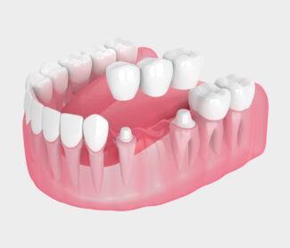 Dental Bridges