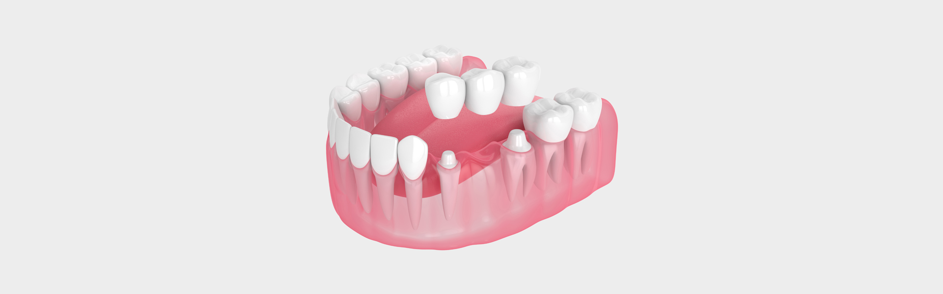 Dental Bridges in Modesto, CA