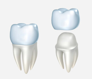 Dental Crowns