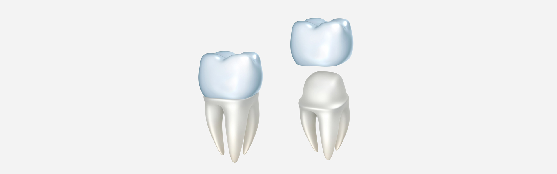 Dental Crowns in Modesto