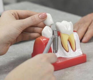 Dental Implants