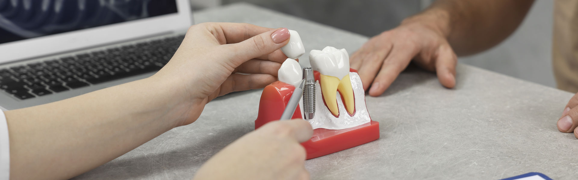 Dental Implants in Modesto, CA