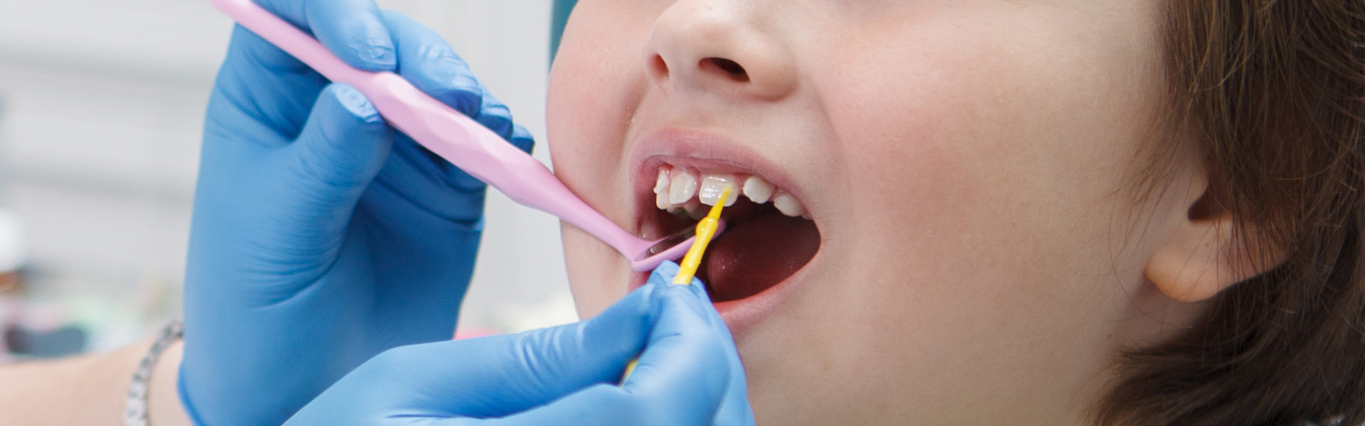 Fluoride Treatment in Modesto, CA