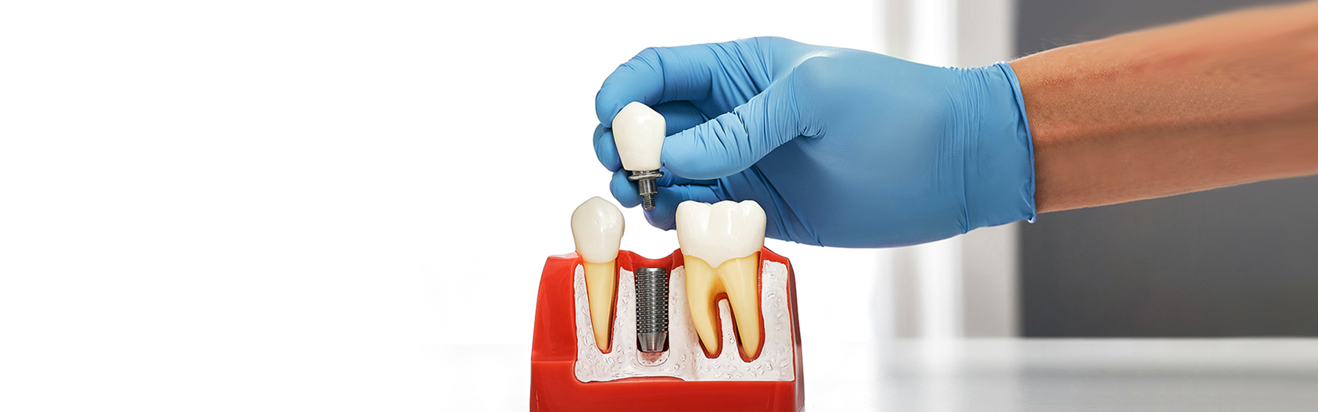 How to Fix a Chipped Tooth – From Minor to Severe Cases