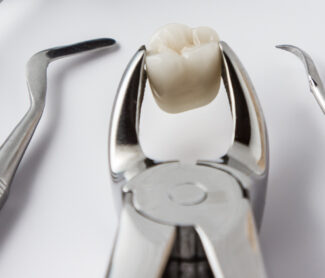 Simple Tooth Extractions