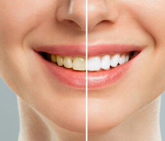 Teeth Whitening