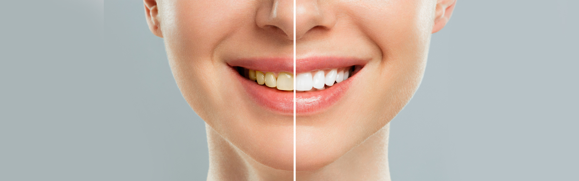 Teeth Whitening in Modesto, CA