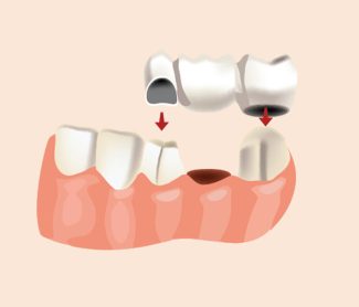 Top 5 Benefits of Getting a Dental Bridge in Modesto, California