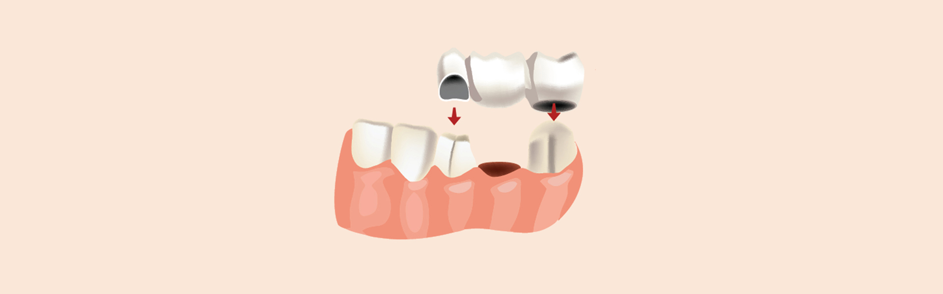 Top 5 Benefits of Getting a Dental Bridge in Modesto, California